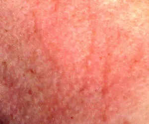 Allergie - Hautausschlag - Urticaria
